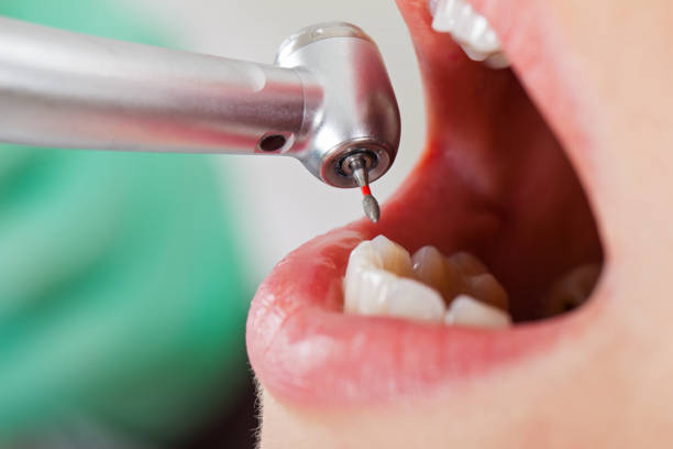 Best Knocked-Out Tooth (Avulsed Tooth) Treatment in Flowood, MS